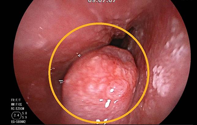 婦人不菸不酒竟罹食道癌，透過內視鏡可看到食道腫瘤（黃圈處）。（南投醫院提供）