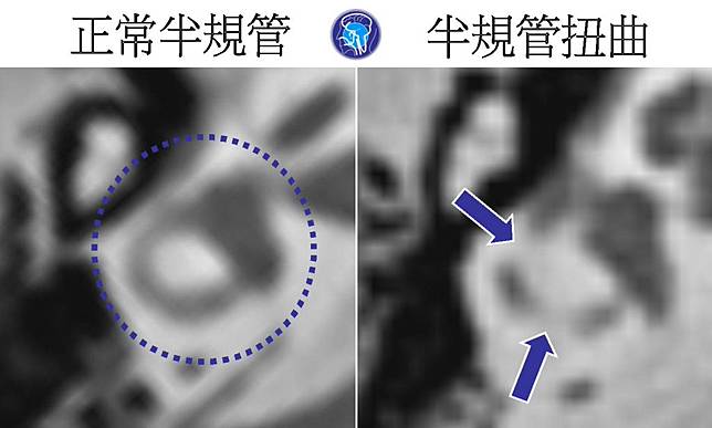 內耳電腦斷層檢查顯示，左圖為正常半規管，在一平面上呈現圓環狀（虛線圈）；右圖為扭曲半規管，無法在一個平面上呈現圓環，而是一節一節的（藍色箭頭處）。（醫師陳建志提供）