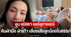 A Warning for Pregnant Mothers! Itchy Palms and Soles: A Danger Sign Not to Be Ignored