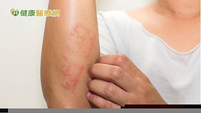異位性皮膚炎是台灣常見的皮膚疾病，根據統計全台有超過200萬名患者，除發作時患部搔癢難耐外，反覆發作的特性，加上影響到外表、社交與人際關係，更讓許多患者頭疼不已。