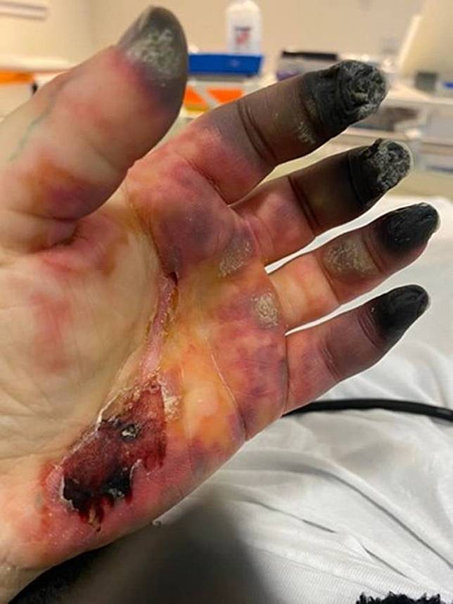 蘇格蘭一名51歲女子不幸在今年3月確診武漢肺炎，重症瀕危搶救回來後出現手指與腳趾發黑壞死的狀況。(翻攝募款頁面)