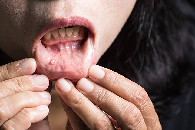 口腔癌早期發現，治癒率高。圖片來源：Shutterstock／達志影像