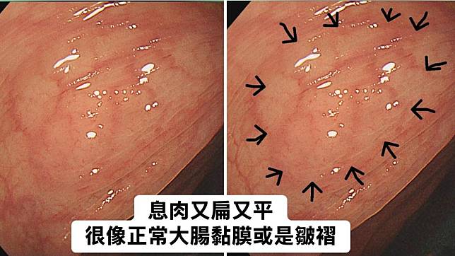 20歲女子罹患「鋸齒狀息肉症候群」，大腸內有超過20顆以上息肉。（圖／翻攝自林相宏臉書）