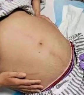 杭州女子便秘超過 10 天，醫生動手術在其腹部取出約一公尺長的「巨蟒」。 圖：翻攝自新浪新聞微博