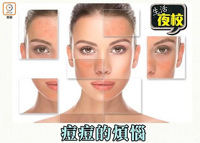 臉上不同部位長痘，也代表著身體的不同部位出現了問題。（互聯網）