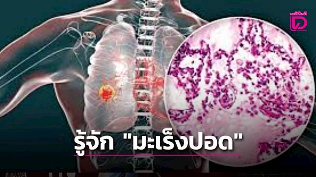 “เผย 7 สัญญาณเตือน ‘มะเร็งปอด’คุกคาม “เอ๋ พรทิพย์” ภัยร้ายคร่าชีวิตประชากรโลกอันดับ1