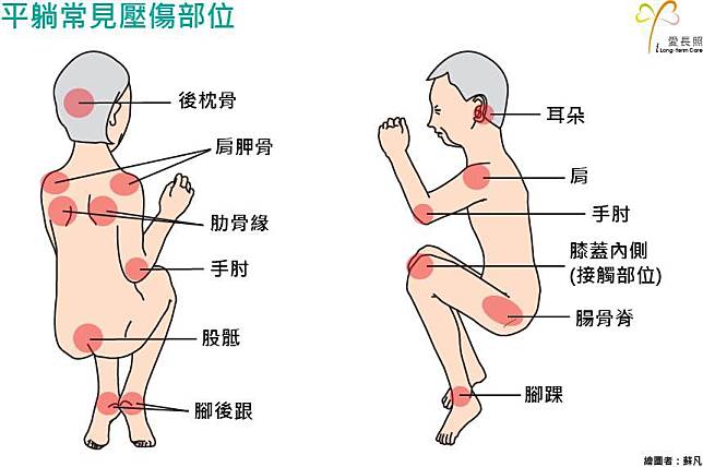 什麼是壓傷（舊名壓瘡）？為什麼壓傷可能造成病人死亡？