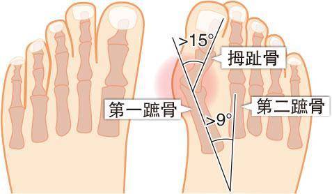 拇趾外翻——第一、二蹠骨角度逾9度，第一蹠骨與拇趾骨角度逾15度，便屬拇趾外翻。（明報製圖）