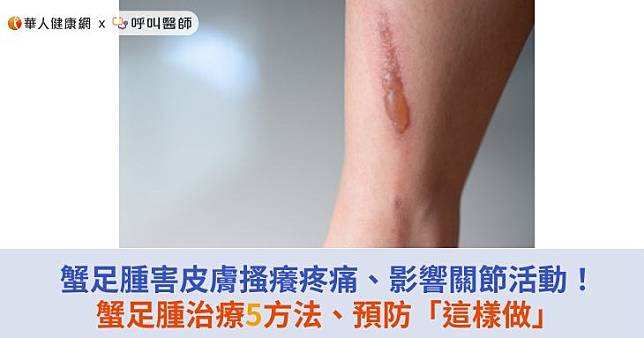 蟹足腫害皮膚搔癢疼痛、影響關節活動！蟹足腫治療5方法、預防「這樣做」