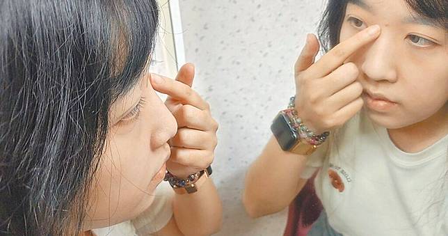臉上痘痘別亂擠！細菌恐經血液跑到腦部　醫師：有生命危險
