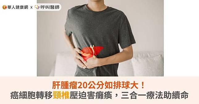 肝腫瘤20公分如排球大！癌細胞轉移頸椎壓迫害癱瘓，三合一療法助續命