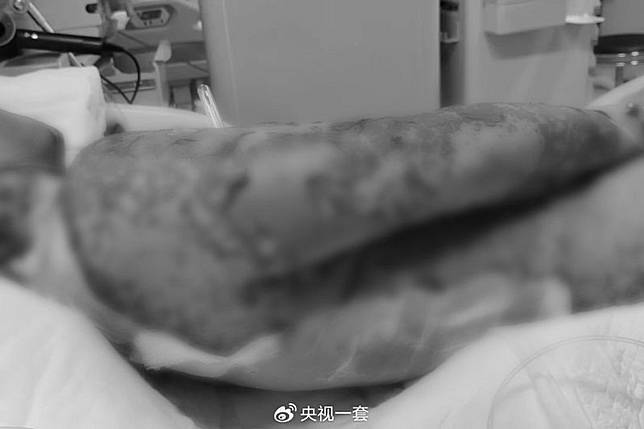 男子酒後吃了3次布洛芬，卻因此皮膚潰爛送醫。圖／翻攝自微博／央視一套
