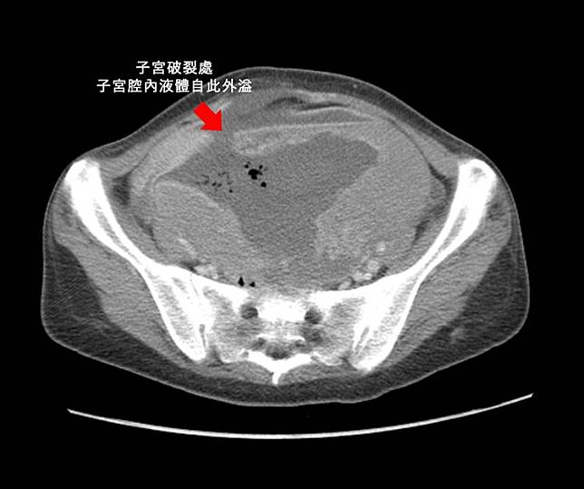 患者子宮破裂情形。醫院提供