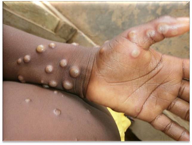 罕見的猴痘病毒(monkeypox virus)正在世界各地傳播。(翻攝自WHO官網)