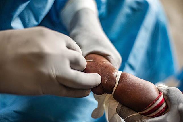 A child caught mpox gets treatment at a hospital in the Nyiragongo territory near Goma, North Kivu province, eastern Democratic Republic of the Congo (DRC), on Aug. 15, 2024. (Photo by Zanem Nety Zaidi/Xinhua)