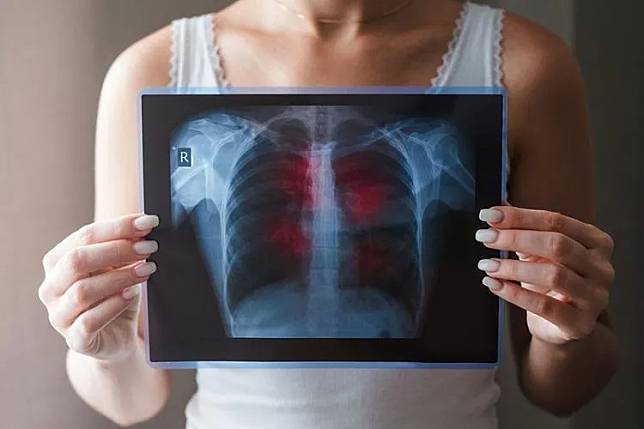 楊老闆確診後感到呼吸困難送至急診，進行胸部X光檢查發現兩肺嚴重發白。（示意圖／資料庫）