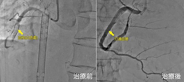 患者治療前後。（圖／澄清醫院提供）