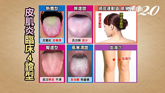 ▲中醫師羅佳琳指出，皮肌炎在舌診時可看出有四證型。