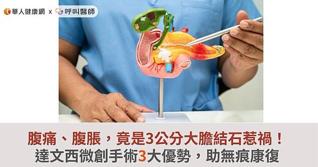 腹痛、腹脹，竟是3公分大膽結石惹禍！達文西微創手術3大優勢，助無痕康復