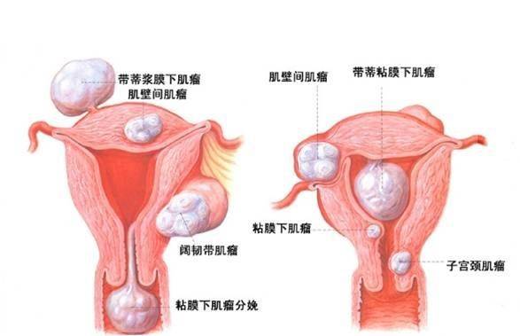 子宮肌瘤