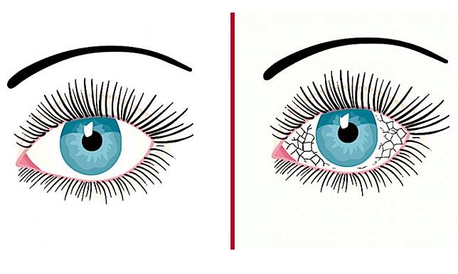 眼睛感染怎知道？認識這5種原因
