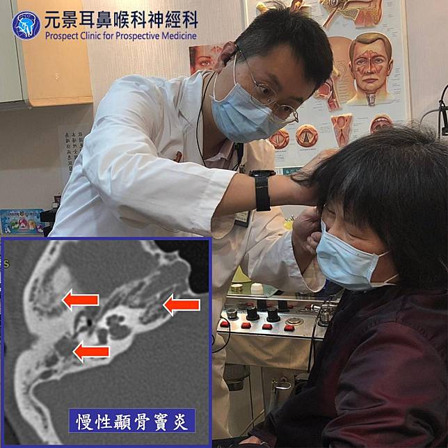 醫師陳建志為患者診療並解釋左下方電腦斷層圖，右側顳骨竇內滿是黏液（紅色箭頭），證實為慢性顳骨竇炎。（醫師陳建志提供）