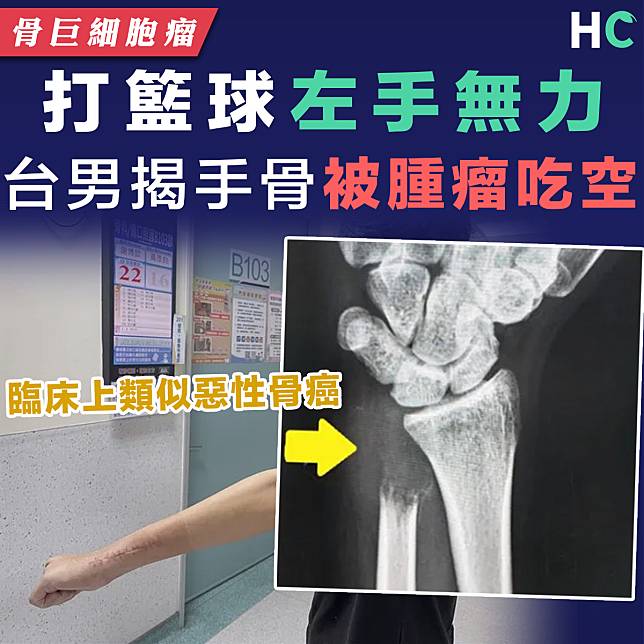 【骨巨細胞瘤】台24歲男子打籃球左手無力  揭手腕尺骨被腫瘤徹底侵蝕