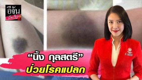 “นิ้ง กุลสตรี” ป่วยโรคแปลก ช้ำทั้งตัว แต่หาสาเหตุไม่เจอ!