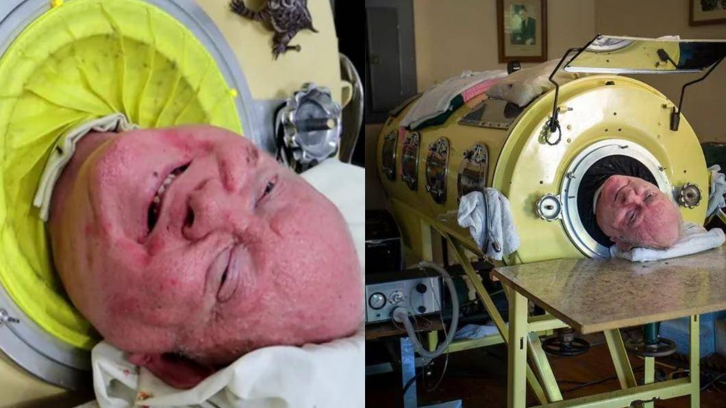 American Man Alexander, ‘Iron Lung Man,’ Sets Guinness World Record for Living in Iron Lung for Over 70 Years, Passes Away at 78: Inspiring Life Story