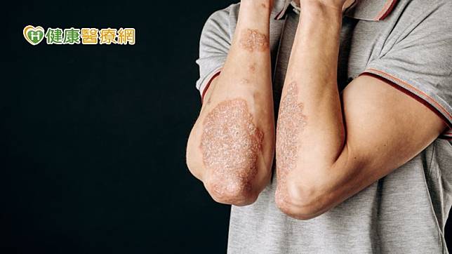 乾癬的發生原因不明，推斷與遺傳、環境有關，除了皮膚紅疹、脫屑之外，體內也處於高度發炎狀態，導致關節發炎出現症狀。