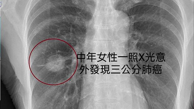 蘇一峰分享一對夫妻雙雙罹肺癌的案例。（圖／翻攝蘇一峰臉書）