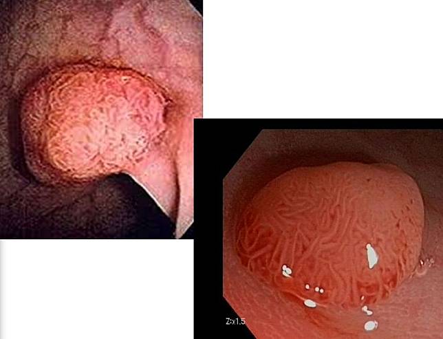 大腸息肉