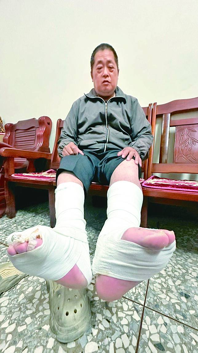 梁再發讀國小六年級時疑因油症影響免疫系統，到今年六十一歲，兩隻腳從膝蓋以下仍反覆腫脹、流膿、噴血，平時都要用紗布裹著。記者劉明岩／攝影