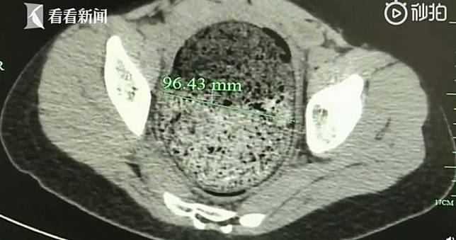 半個月沒大便！女高中生「子宮被擠扁」…灌腸一夜排出4公斤