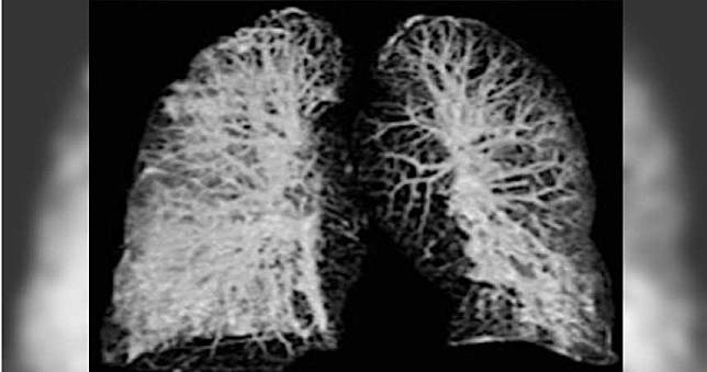 歐洲首2起確診案例肺部重創！出現「毛玻璃狀斑塊」濃液塞滿