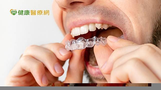 一名男子透過網路購買便宜的隱形牙套，竟然導致門牙鬆動、牙齦萎縮。牙醫說明，民眾若低估了牙套對於牙齒的作用力，甚至遺漏事前檢查蛀牙或牙齦疾病，就有可能會失去牙齒。