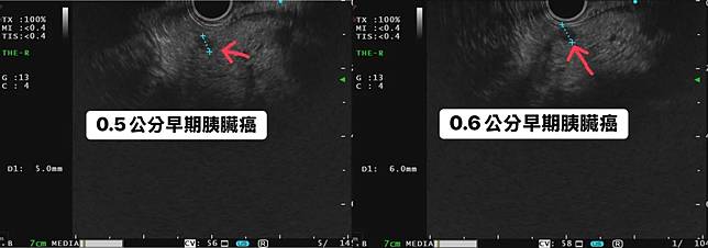 50歲男性因家族癌症病史強烈，就醫篩檢意外發現胰臟裡有兩顆腫瘤。（圖／翻攝自臉書「胰臟醫師 林相宏 禾馨民權內科診所」）