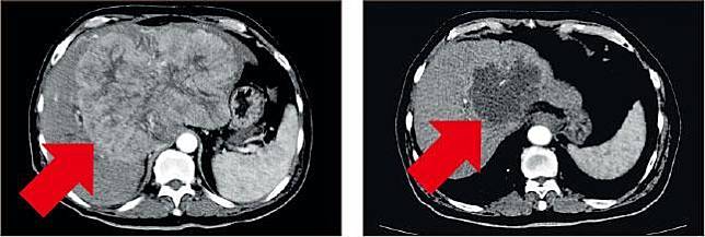 腫瘤壞死——治療前（左）及治療後（右），掃描影像顯示治療腫瘤完全壞死。（作者提供）