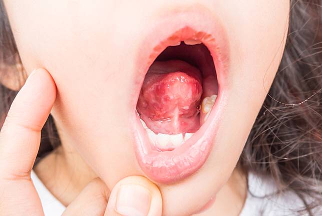 เฮอร์แปงไจน่า: ตุ่มแผลในปาก เริ่มระบาดในเด็กแล้ว