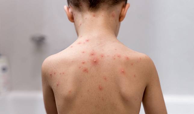 以為蚊子狂叮40個包？？女童全身「紅豆冰」卻被確診為水痘，家醫科醫生：即使打過疫苗，還是會得