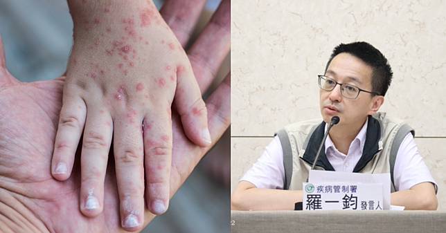 雙北爆麻疹群聚！女赴越南旅遊染病傳同事，接觸者達235人，也曾到台中，發布相關活動史