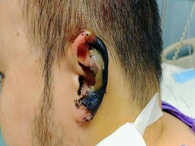 接回失敗！香港區議員耳朵被咬　耳廓壞死