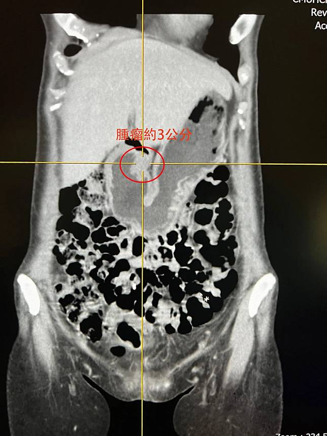 一名約52歲女性，經健檢發現胃潰瘍和息肉，透過切片病理檢查，發現是胃癌第二期。（圖／中國醫藥大學新竹附設醫院提供）