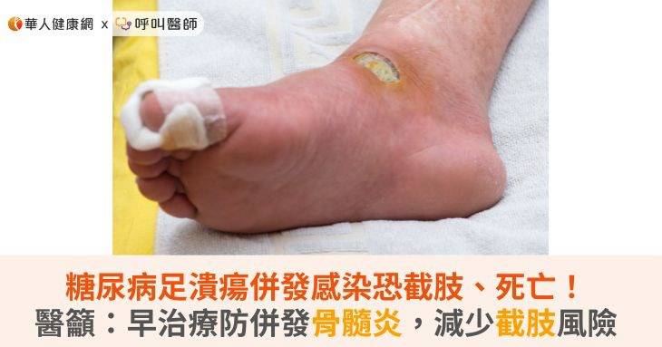 糖尿病足潰瘍併發感染恐截肢、死亡！醫籲：早治療防併發骨髓炎，減少截肢風險 | 華人健康網 | LINE TODAY