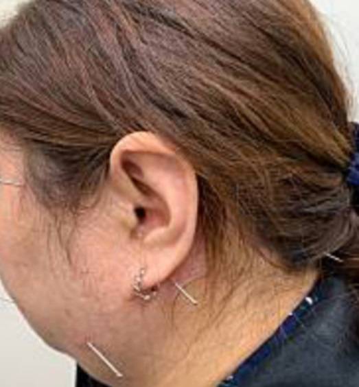 一名女性因病毒感染，導致左臉頰顏面神經麻痺，經過一個多月、20多次的針灸治療漸漸康復。  （記者曾芳蘭翻攝）