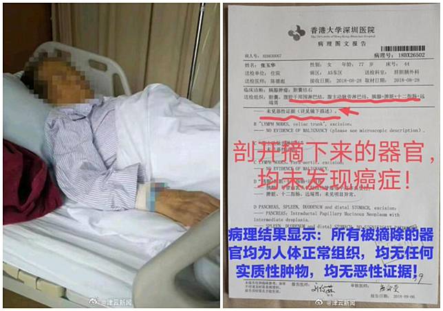 七旬婦無腫瘤被切5器官，港大深圳醫院被判負全責。（微博）