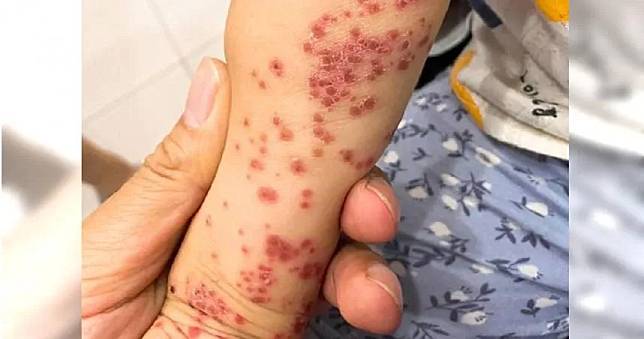 感染腸病毒的孩童，整隻手布滿紅疹及抓到潰爛的水泡，模樣令人心疼。（圖／擷取自Facebook／威力醫師的育兒週記-王韋力）
