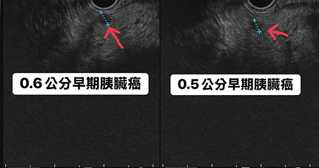 不菸不酒中年男接受健檢　醫師檢查發現2顆超迷你「癌王」