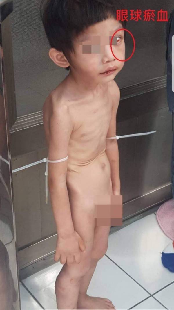 男童被發現時眼球瘀血，骨瘦如柴，雙臂還被綁束帶。(取材自臉書)