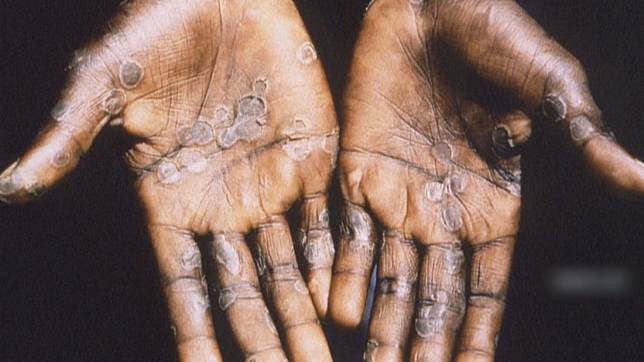 猴痘將從2月1日起改名M痘，避免污名化。（資料照、AFP）